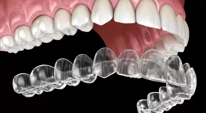 Invisalign: Telsiz Ortodonti ile Konforlu Gülüşler